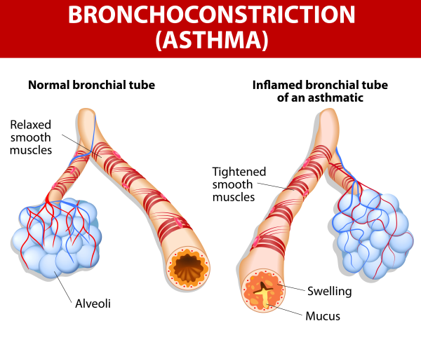 Asthma or Bronchoconstriction - Pooler GA