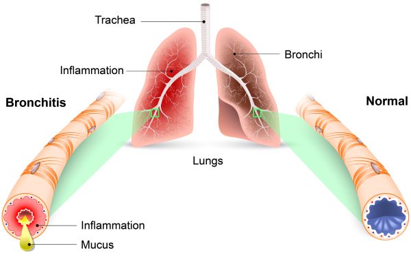 Lung Disease | Lung Health - Pooler GA