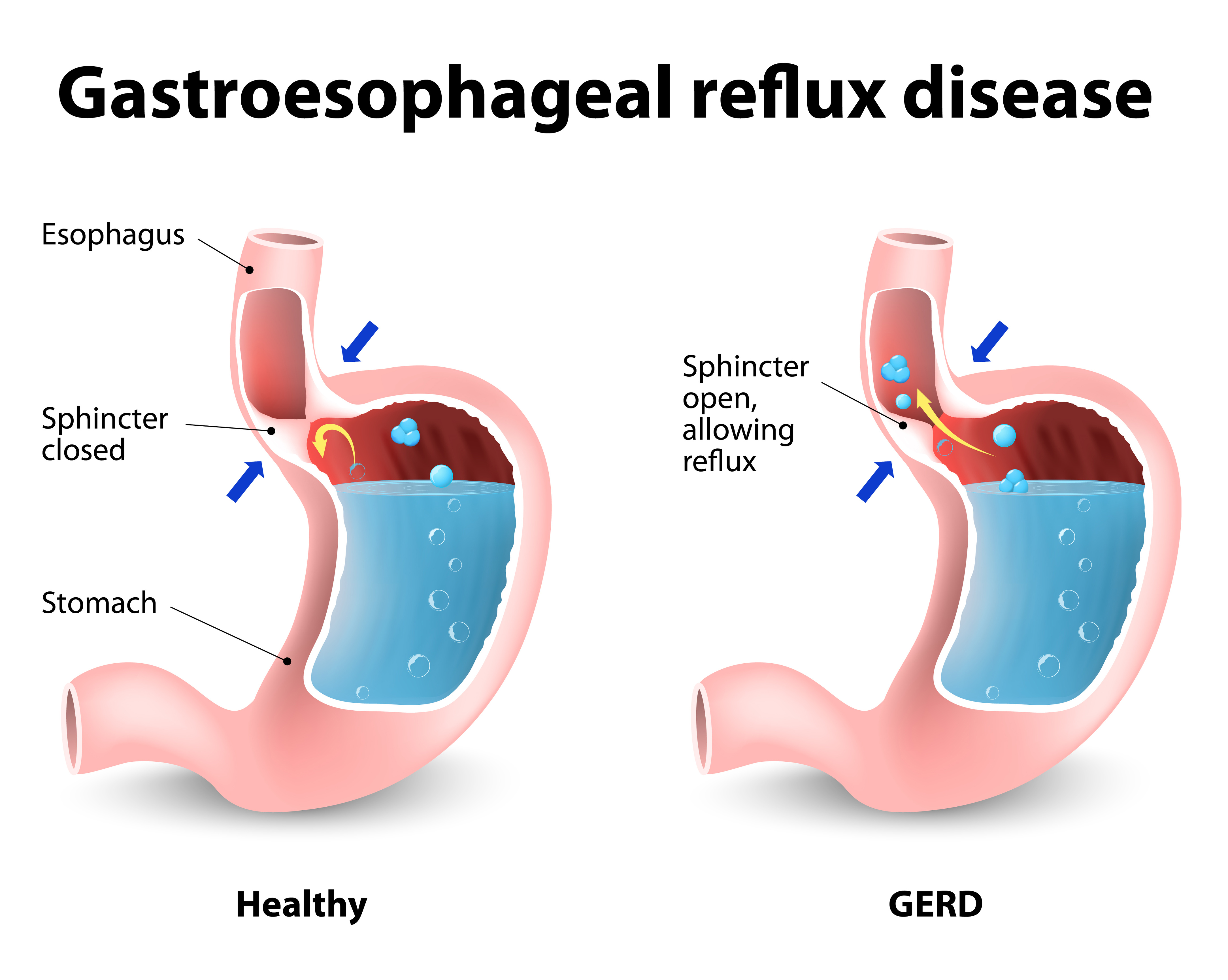 gastroesophageal acid reflux